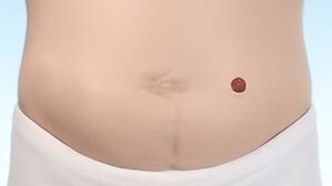 Understanding your stoma | BodyCheck from Coloplast ...