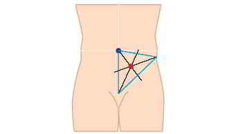 Stoma siting