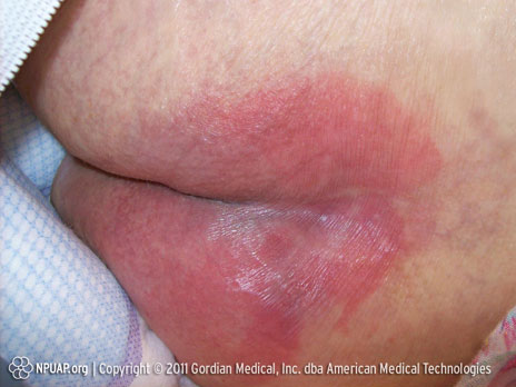 Pressure ulcer Category/Stage I: Non-blanchable redness of intact skin Pressure ulcer Category/Stage I: Non-blanchable redness of intact skin