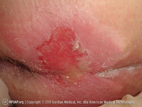 Pressure ulcer Category/Stage II: Partial thickness skin loss or blister Pressure ulcer Category/Stage II: Partial thickness skin loss or blister