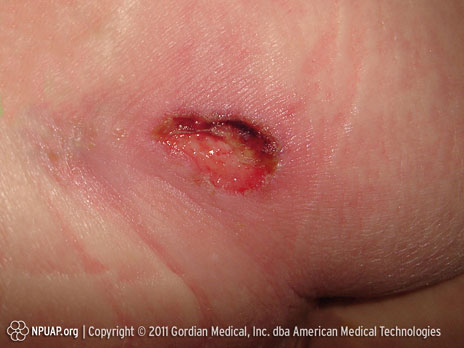 Pressure ulcer Category/Stage III: Full thickness skin loss (fat visible) Pressure ulcer Category/Stage III: Full thickness skin loss (fat visible)
