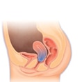 Uterine prolapse