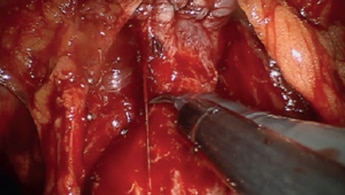 Prostatectomy Procedure