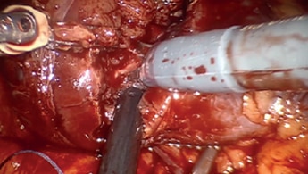 Partial Nephrectomy