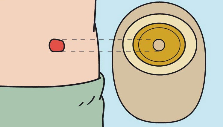 check stoma size