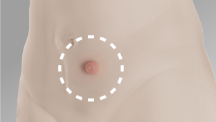 Regular area of stoma on abdomen