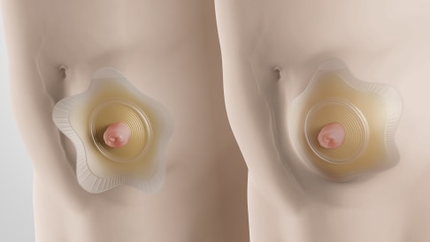 Sensura Mio Concave for people with curves, bulges or hernias.