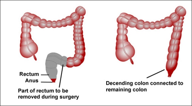 Managing Anterior Resection Toolkit