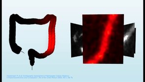 Scintographics showing the bowel before and after Peristeen use