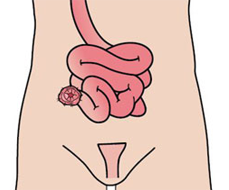 Ileostomy