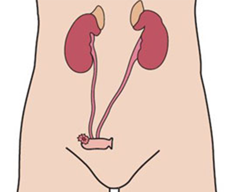 Urostomy