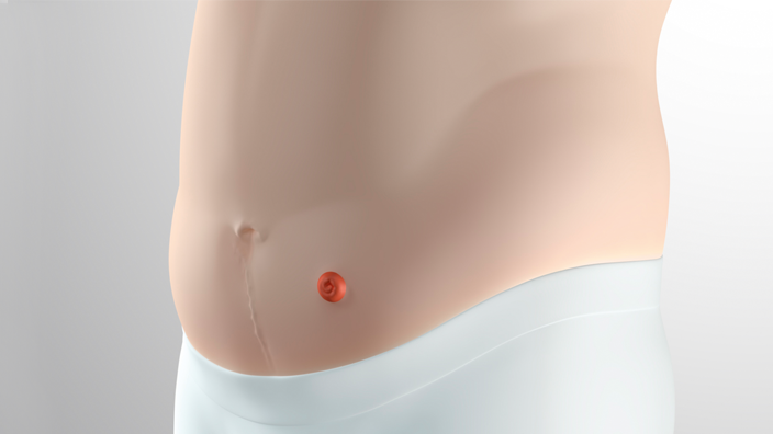 Regular peristomal area